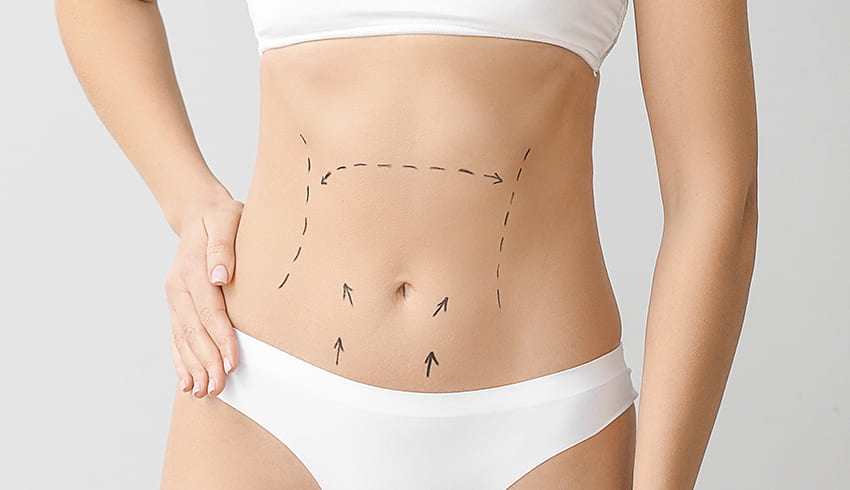 Abdominoplastia